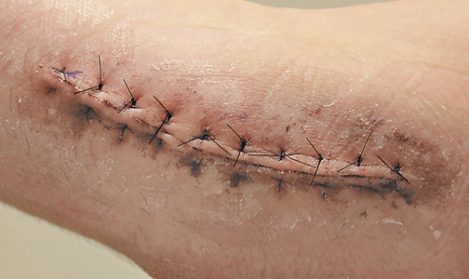 Elbow Surgery Epidemic Doesn’t Slow Down